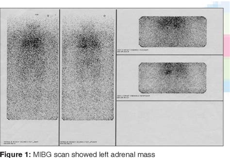 Figure 1 From Composite Pheochromocytoma Ganglioneuroma Of The Adrenal Gland A Case Report With