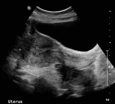 Ovarian Torsion Radiology Case Radiopaedia Org