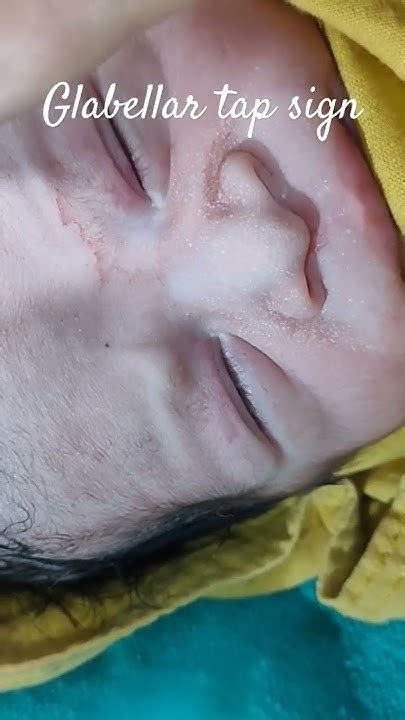 glabellar tap sign primitive reflex tap sign paediatric