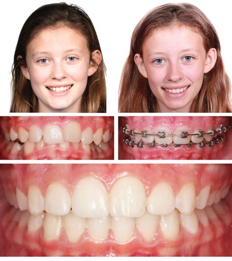 Orthodontics in Kansas City ,Gladstone Orthodontist ,Parkville ...