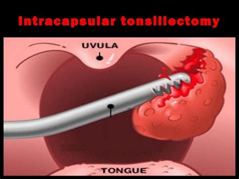 4tonsillectomy Adenoidectomy And Quinsy