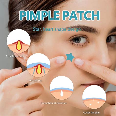 New suction patches will prevent future exploding zits 1