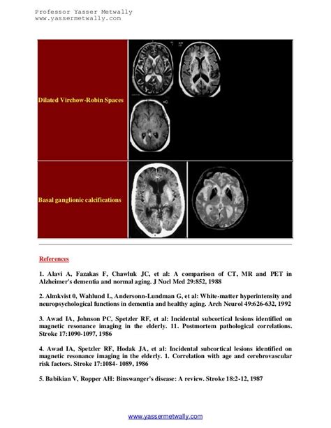 Radiological Pathology Of Ischemic Microvascular Brain Diseasean Upd