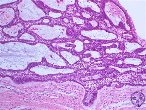 7oral Salivary Gland 5 Odontogenic Tumors Ameloblastomapathology