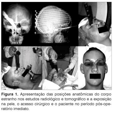 Scielo Brasil Traumatismo Cr Nio Facial Por Arma Branca Traumatismo