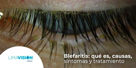 Blefaritis Qu Es Causas S Ntomas Y Tratamiento