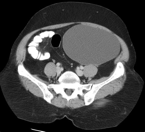 Mucinous Cystadenoma Ovary