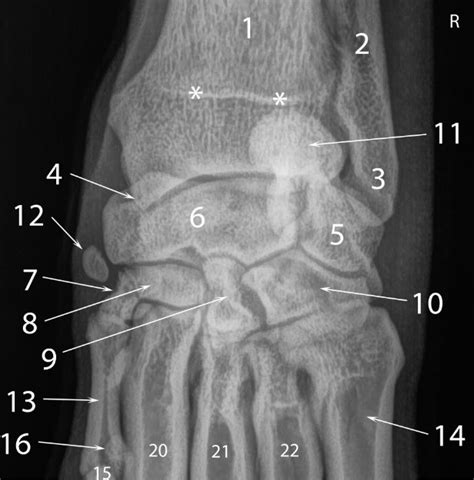 Carpus Radiograph Diagram Quizlet