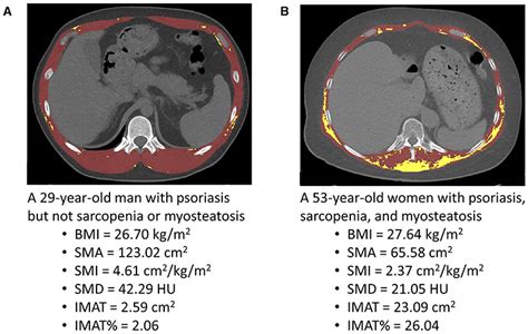 Frontiers Psoriasis Is Associated With Myosteatosis But Not