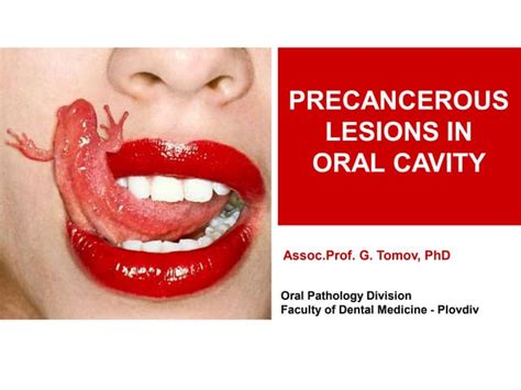 Precancerous Lesions In Oral Cavity Ppt