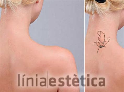 Eliminaci N De Tatuajes Lleida Con Laser De Pulso Corto L Nia Est Tica