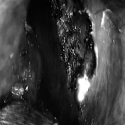 creation   ostium   laser  scientific diagram