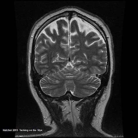 Intraparietal Sulcus Mri