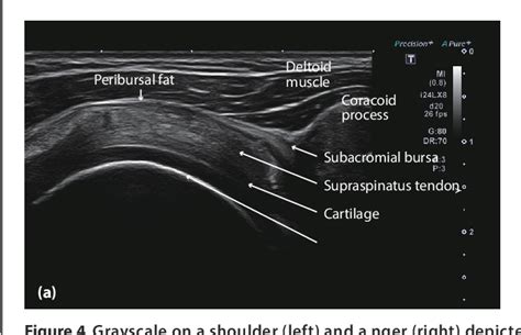 Figure From Clinical Value Of Superb Micro Vascular Imaging And Ultra