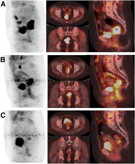 Pet Scan Colon Cancer