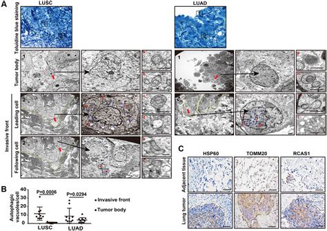 Autophagic Flux In Cancer Cells At The Invasive Front In The Tumor