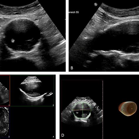 a, b B-mode ultrasound images of the infrarenal abdominal aorta show an... | Download Scientific ...