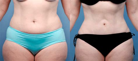 Flank Liposuction Everything You Need To Know 2024 60 OFF