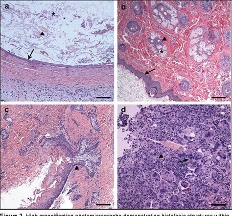 Table 2 From Craniofacial Dermoid Cysts Histological Analysis And