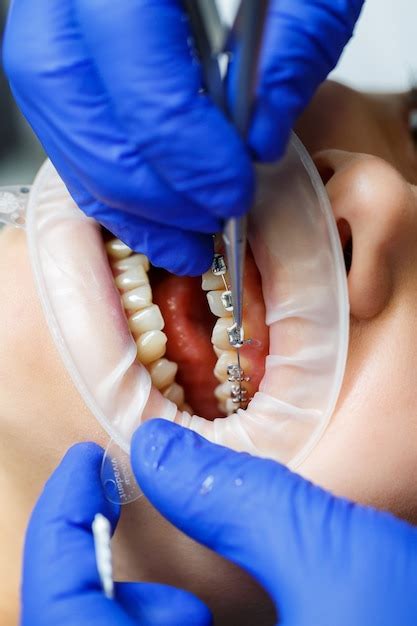 Premium Photo The Orthodontist Puts Metal Braces On The Patient S