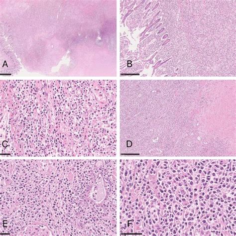 The Tumor Cells Are Diffusely Distributed Infiltrating The Entire