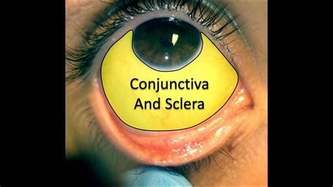 Conjunctiva And Sclera