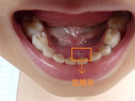 孩子长双排牙怎么办 新桥口腔