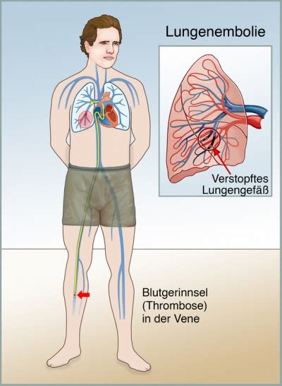 Lungenembolie Ursachen Symptome Behandlung MedLexi De