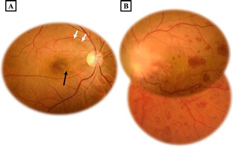 A Fundus Photograph Of The Right Eye Exhibiting An Epiretinal Membrane