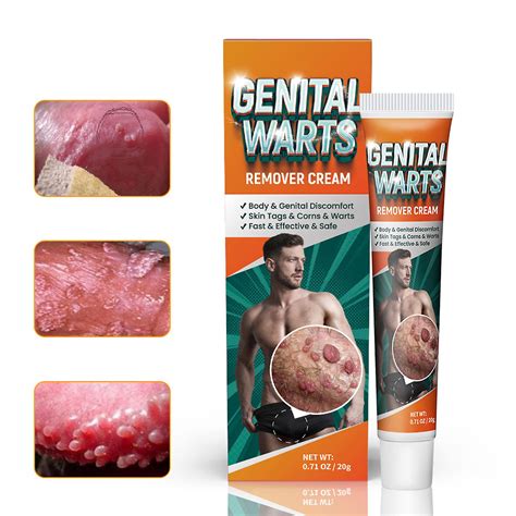 Wart Remover Cream Tratamento De Verruga Genital Creme De Remo O De