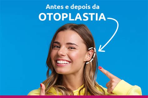 Antes E Depois Da Otoplastia Projeto Orelhinha