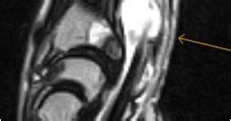 Space of Parona Infection-MRI - Sumer's Radiology Blog