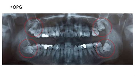 Radiographic Assessment Of Impacted Teeth Ppt