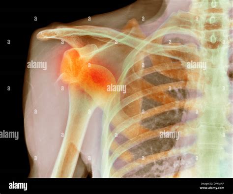 Schulter röntgen Fotos und Bildmaterial in hoher Auflösung Alamy