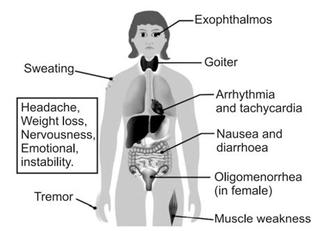 Graves Disease Causes Symptoms Treatment Solution Parmacy