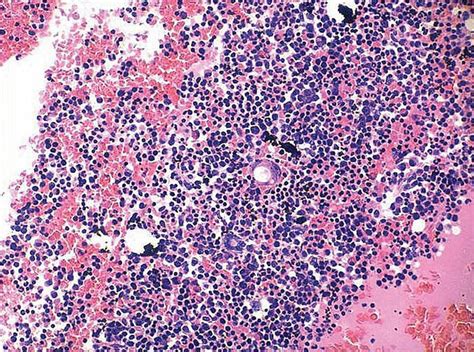 Figure 4 Castlemans Disease A Rare Lymphoproliferative Disorder