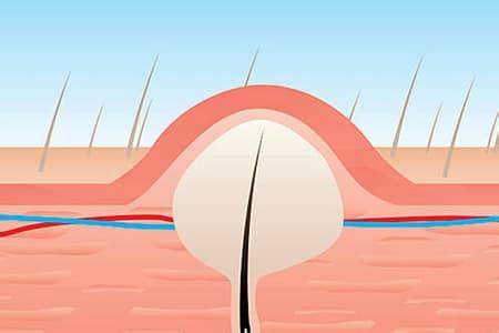 Pilonidal Sinus Causes Symptoms Treatment And Prevention