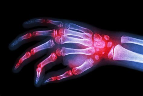 Rheumatoide Arthritis Neuigkeiten In Diagnostik Und Therapie MedMix