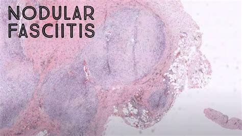 Nodular Fasciitis Under The Microscope Soft Tissue Pathology Dermpath