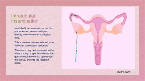 Assisted Reproductive Techniques Ppt