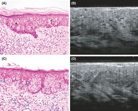 Extramammary Paget S Disease Case 5 A B Prototypical Pattern Of