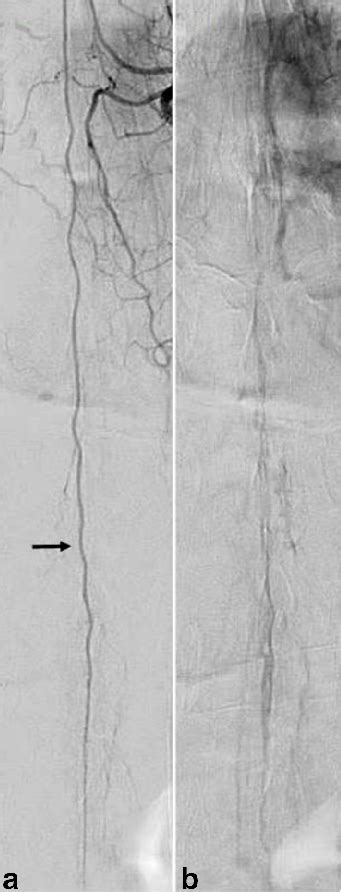 Frontal Projection Spinal Digital Subtraction Angiography In The Download Scientific Diagram