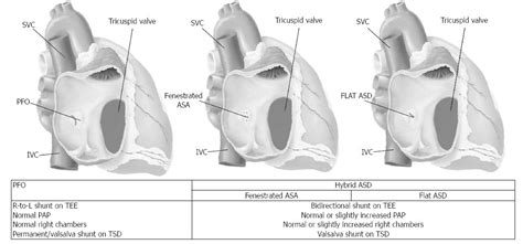 Patent Foramen Ovale Vs Atrial Septal Defect