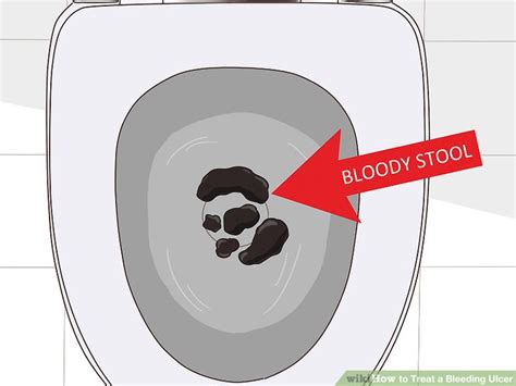 How to Treat a Bleeding Ulcer: 14 Steps (with Pictures) - wikiHow