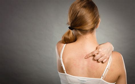 Preventing Back Acne Breakouts U S Dermatology Partners Blog