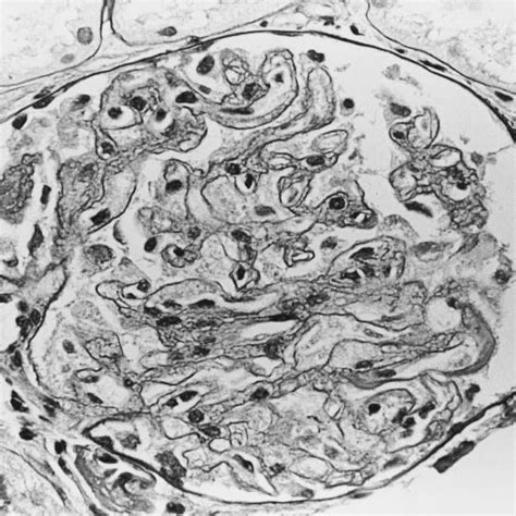 Light Photomicrograph Of A Glomerulus From A Patient With Pre Eclampsia