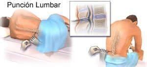 Posiciones Para Realizar Una Puncion Lumbar Imagen Diagn Stica Y