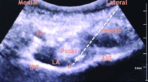 Ultrasonographic view during PENG block. AIIS = anterior inferior iliac... | Download Scientific ...