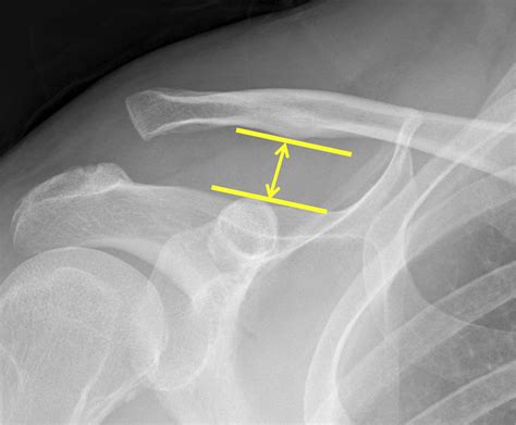 Comparison Of Hook Plate Fixation Versus Arthroscopic Coracoclavicular