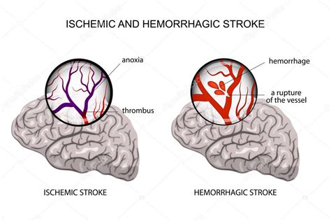 hemorrhagic and ischemic stroke